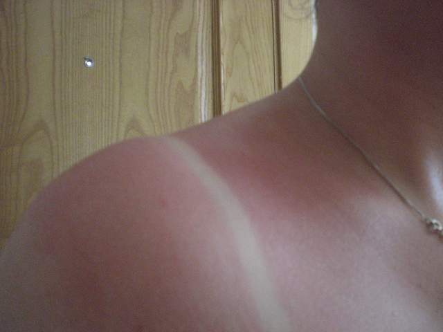 First day burn
